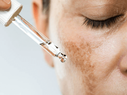 기미 있는 얼굴