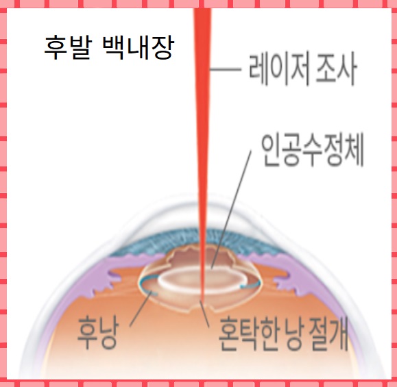 후발 백내장