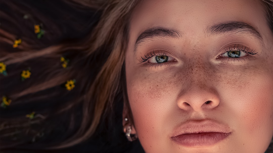freckles
