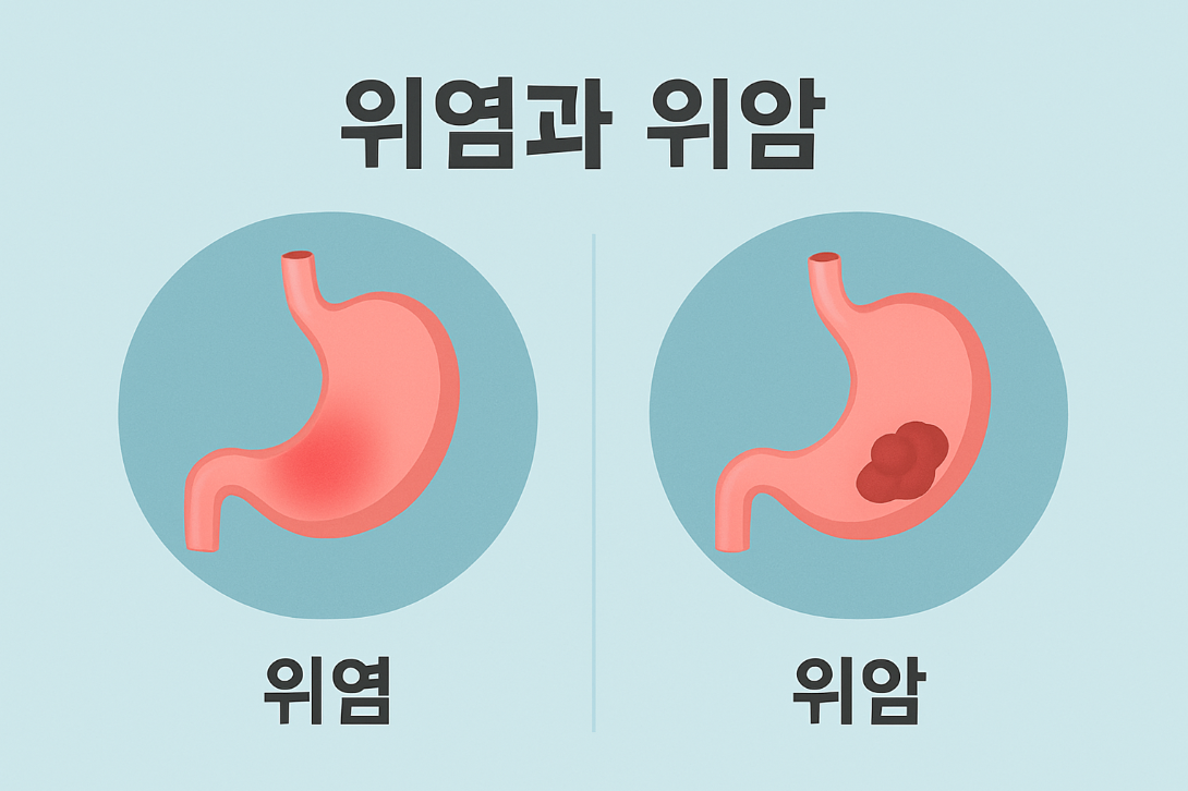 위염과 위암, 증상 구분하는 방법