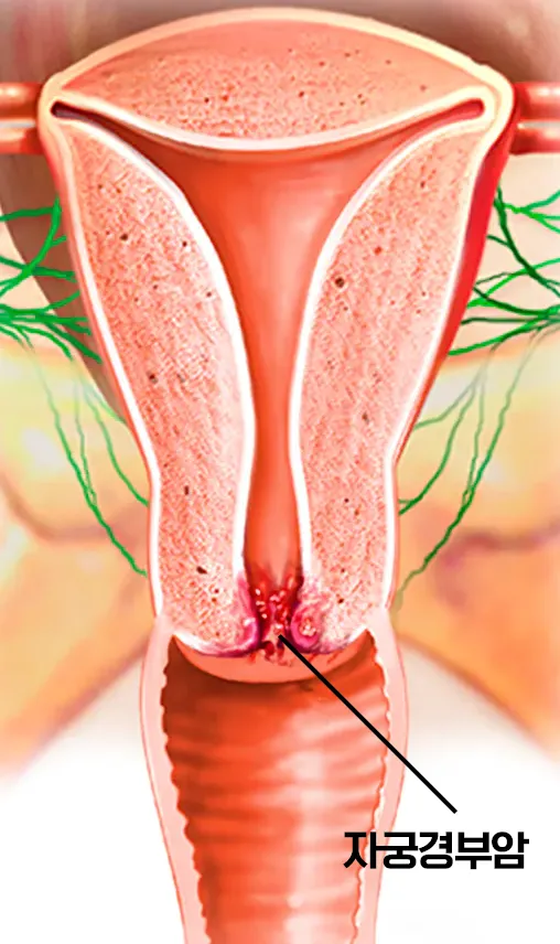 자궁경부암 위치