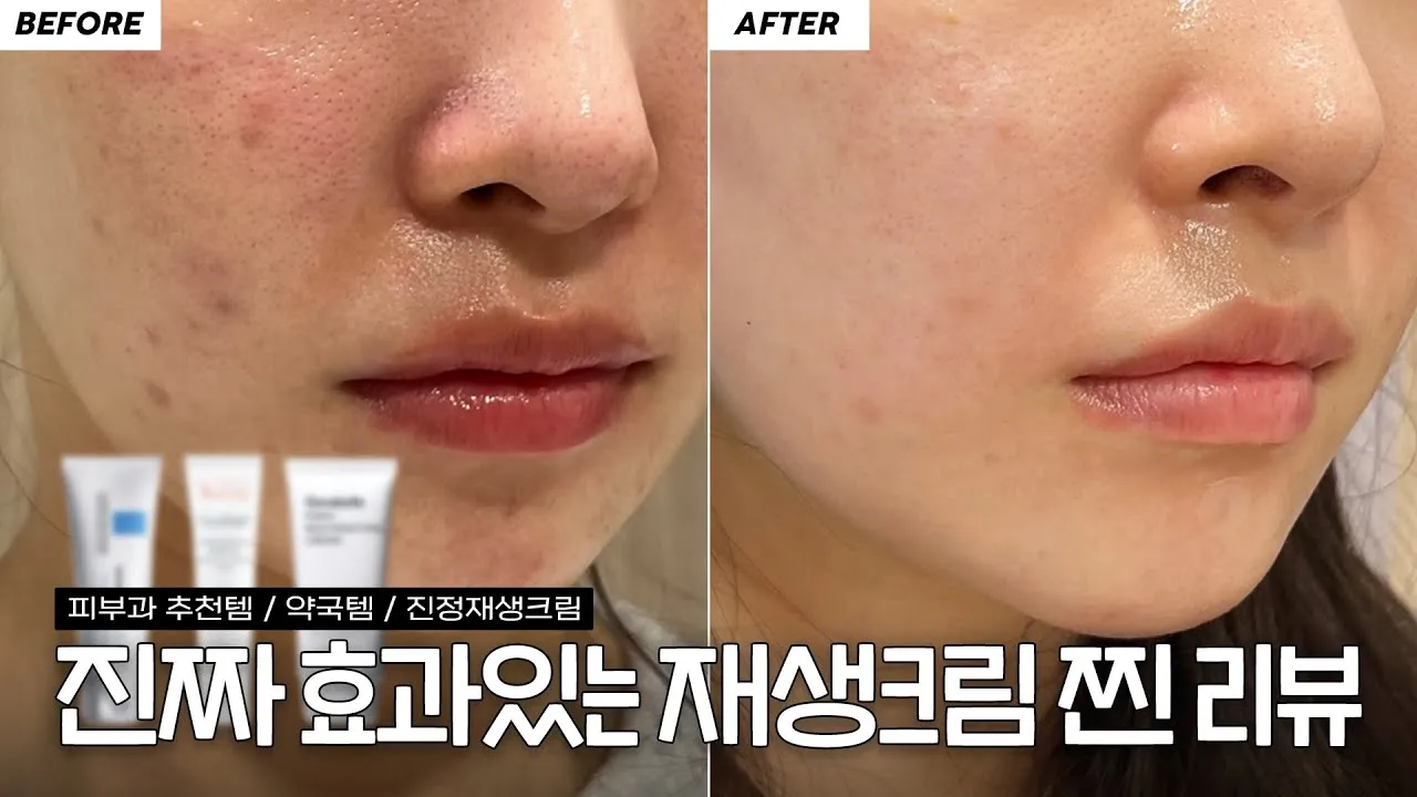 여드름 재생크림 클렌징폼 꿀템 10선_1