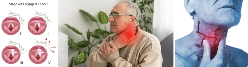 후두암 기수별 생존율