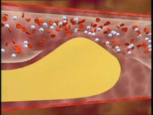 콜레스테롤 정상수치