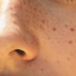 기미 완화 방법