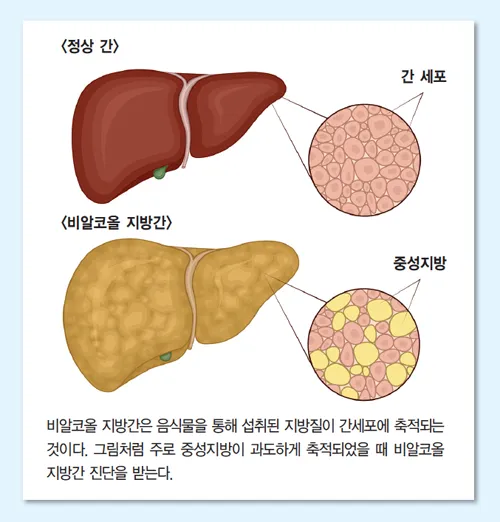 비알콜성 지방간 없애는 방법 운동 식단 중심 회복법 정리_3