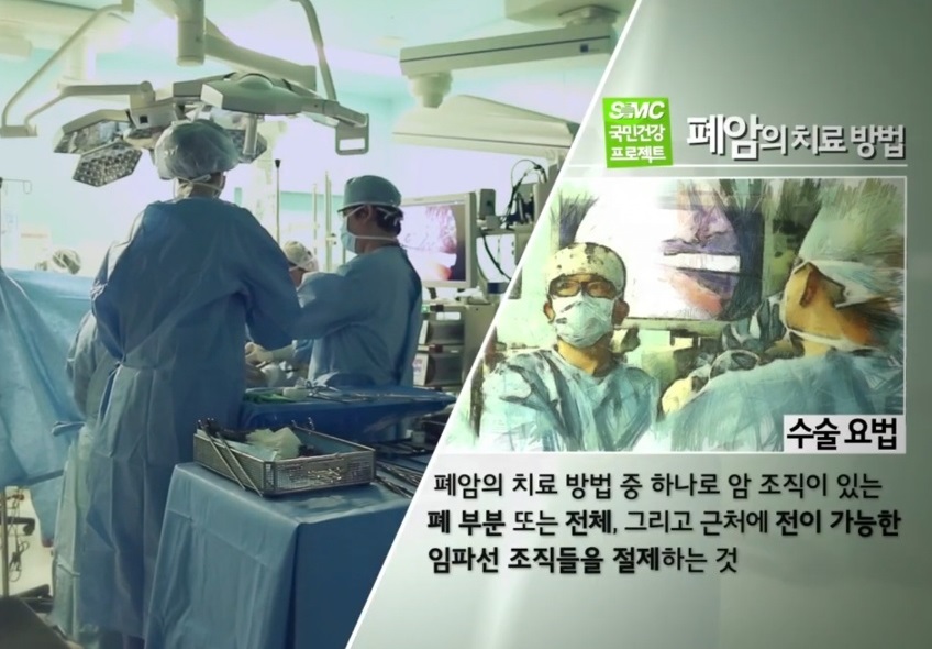 폐암치료방법