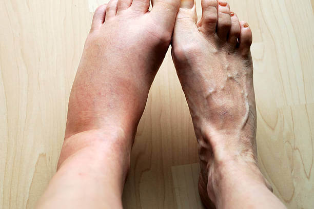 센시아 효능&amp;#44; 정맥순환 개선&amp;#44; 정맥순환 장애는 남녀 모두에게 나타나지만 여성에게 더 자주 발생하는 것으로 보고되고 있습니다. 여성의 유병률이 높은 이유는 임신 시 커진 자궁이 하지정맥을 압박하고 임신 중 과체중이 정맥혈관에 악영향을 미치기 때문입니다. 다리부종이 센시아가 어떤 작용을 하는지 읽어 보시기 바랍니다. 