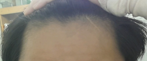 남성 탈모 대부분을 차지하는 유형 중 M자 탈모의 원인과 두타스테리드(아보다트)치료와 부작용 그리고 주의 사항 및 5년 간 실제 복용 후기