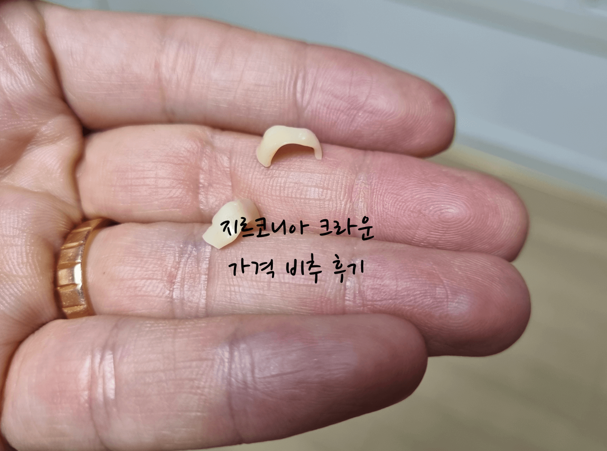 지르코니아 크라운 깨짐