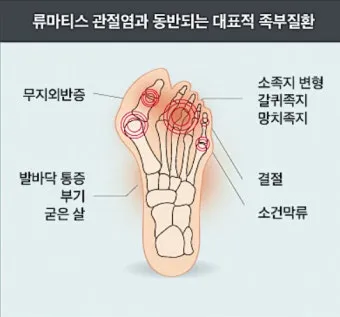 효과적인 류마티스 관절염 치료제 추천 약물 비교 가이드 2025 최신판_2