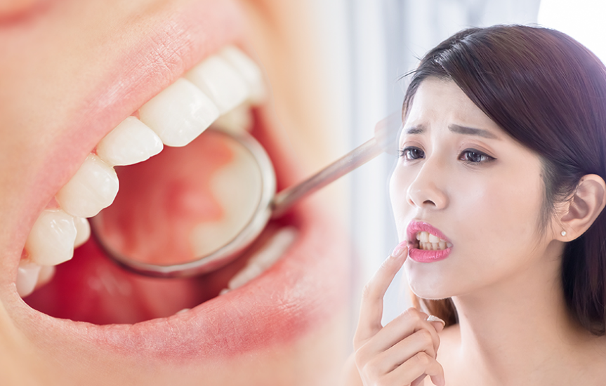 구강암 치료 방법