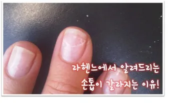 손톱이 갈라지는 이유 원인 증상 대처법_11