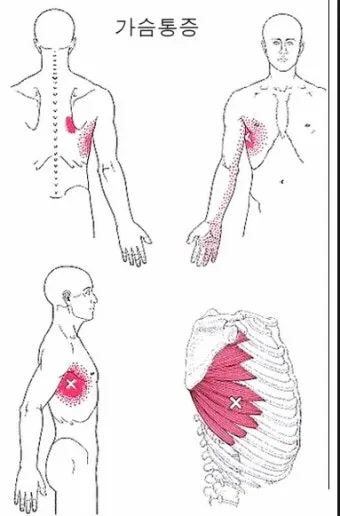 여자 오른쪽 겨드랑이 콕콕 유방암 증상일까 놓치기 쉬운 신호로_9