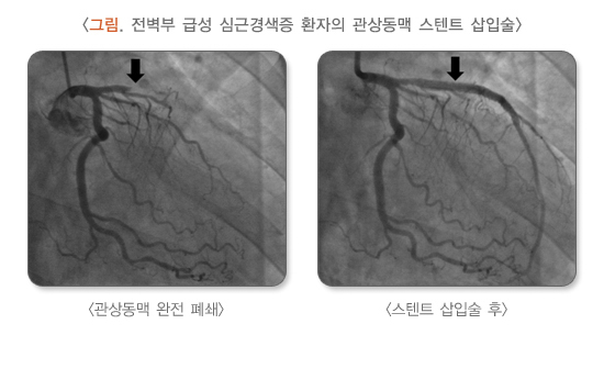 심근경색 스텐트 삽입술
