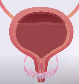 테이프에 과도한 장력을 풀어준 이미지