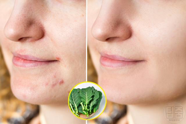 여드름흉터 치료 여드름흉터 없애는법 자연치유