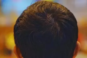 모발이식-3000모-비용