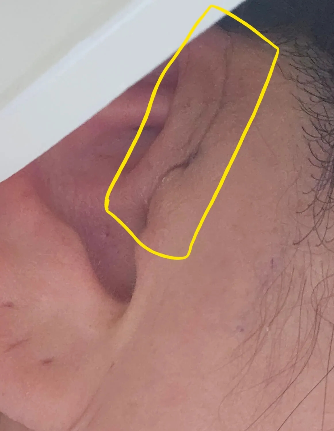 [성모병원 수술후기] 선천성 이루공 전신마취 수술&amp;#44; 의정부성모병원 입원 리얼경험