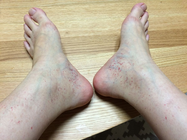 다리 혈관염 증상 - 초기 단계, 작은 점상 출혈