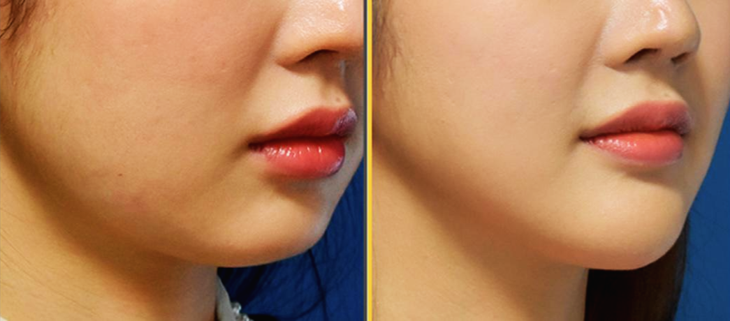 울쎄라 가격 효과 시술이 필요한 경우