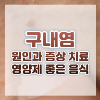 구내염, 구내염원인, 구내염치료, 구내염약, 구내염음식, 구내염영양제, 입병, 구강건강, 구내염예방, 구내염전염성