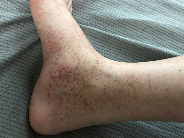 자반증 초기증상 - 점상 출혈, 붉은 반점