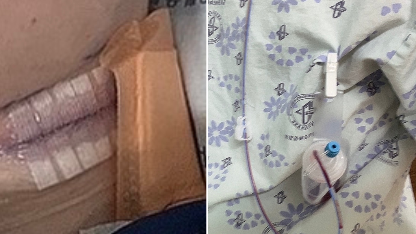 실제 수술 후 사진