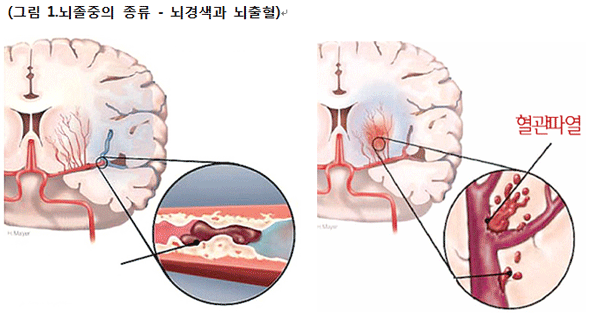 뇌졸중 초기증상