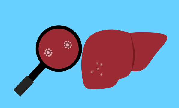 간암 원인 : 간염