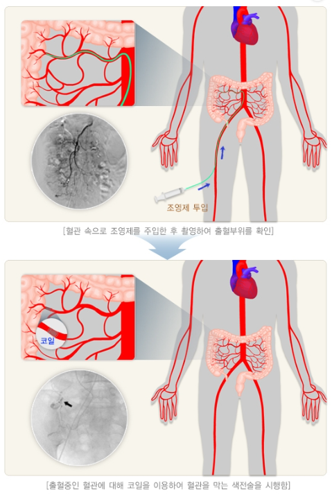 혈관조형술을 통한 색전술