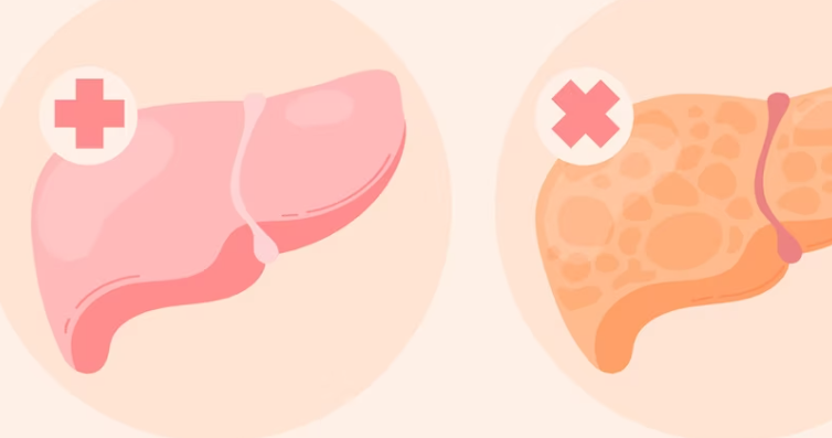 담도 폐색을 치료하는 방법 담관조영술