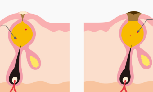 흰 여드림, 검은 여드림