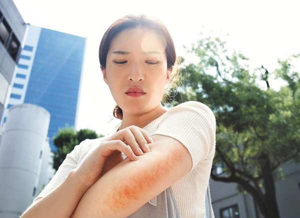 화상 입었을 때