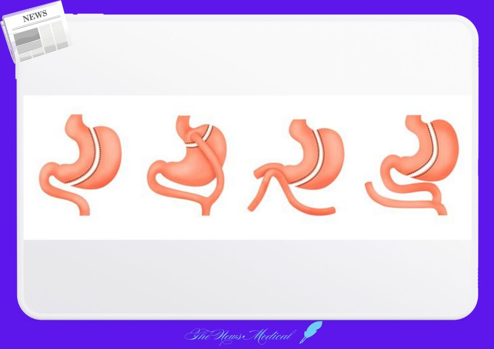 비만대사수술의 다양한 수술법