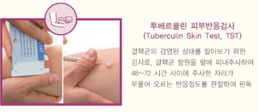 잠복 결핵검사 및 증상&#44; 치료&#44; 비용까지 알아봤습니다. 한국에서 결핵은 남성보다 여성이 노인보다 젊은 세대에 더 많이 발생한다고 합니다. 중요하게 보는 원인은 음식이나 스트레스가 원인인 것으로 보고 있습니다. 어떤식으로 치료가 진행되는지 꼼꼼히 읽어 보시기 바랍니다.