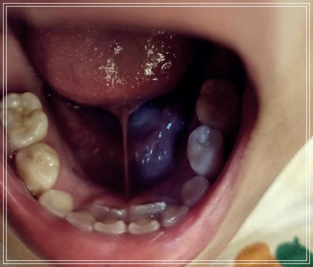 설측 맹출 생기는 이유? 원인 해결방법.