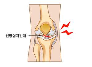 무릎십자인대파열