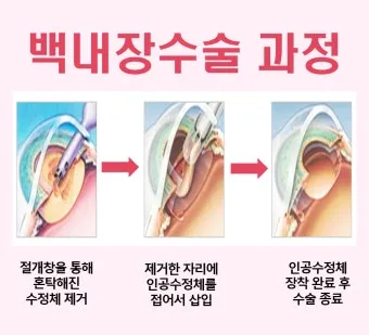 백내장 수술 비용 실비 보험 청구 회복기간_16