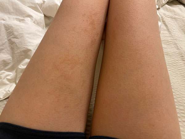 저온화상 증상 일주일째