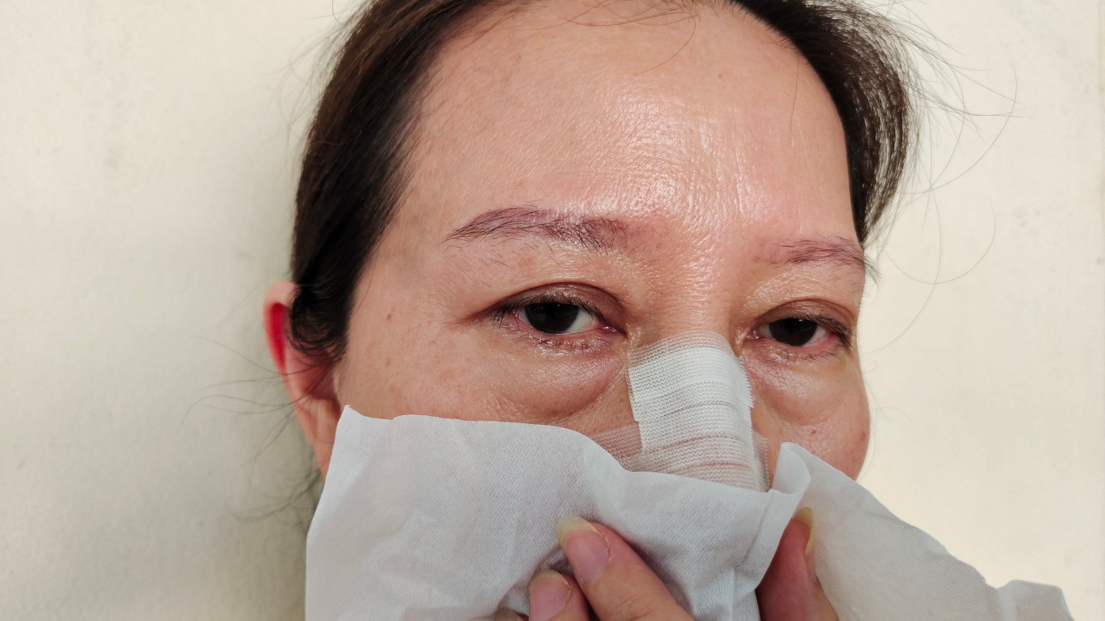 내시경 부비동 수술(Functional Endoscopic Sinus Surgery, FESS)