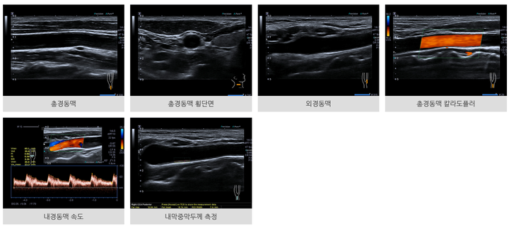 경동맥 초음파 검사란? mra 플라크 수치