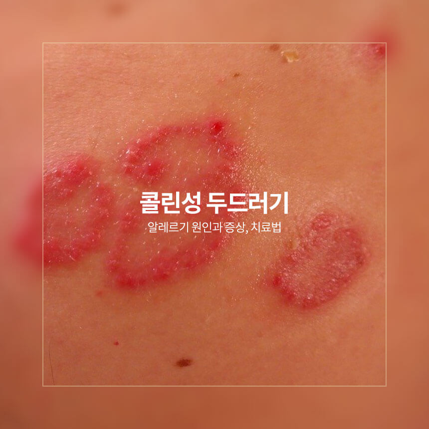 “콜린성-두드러기-원인과-증상-치료법”