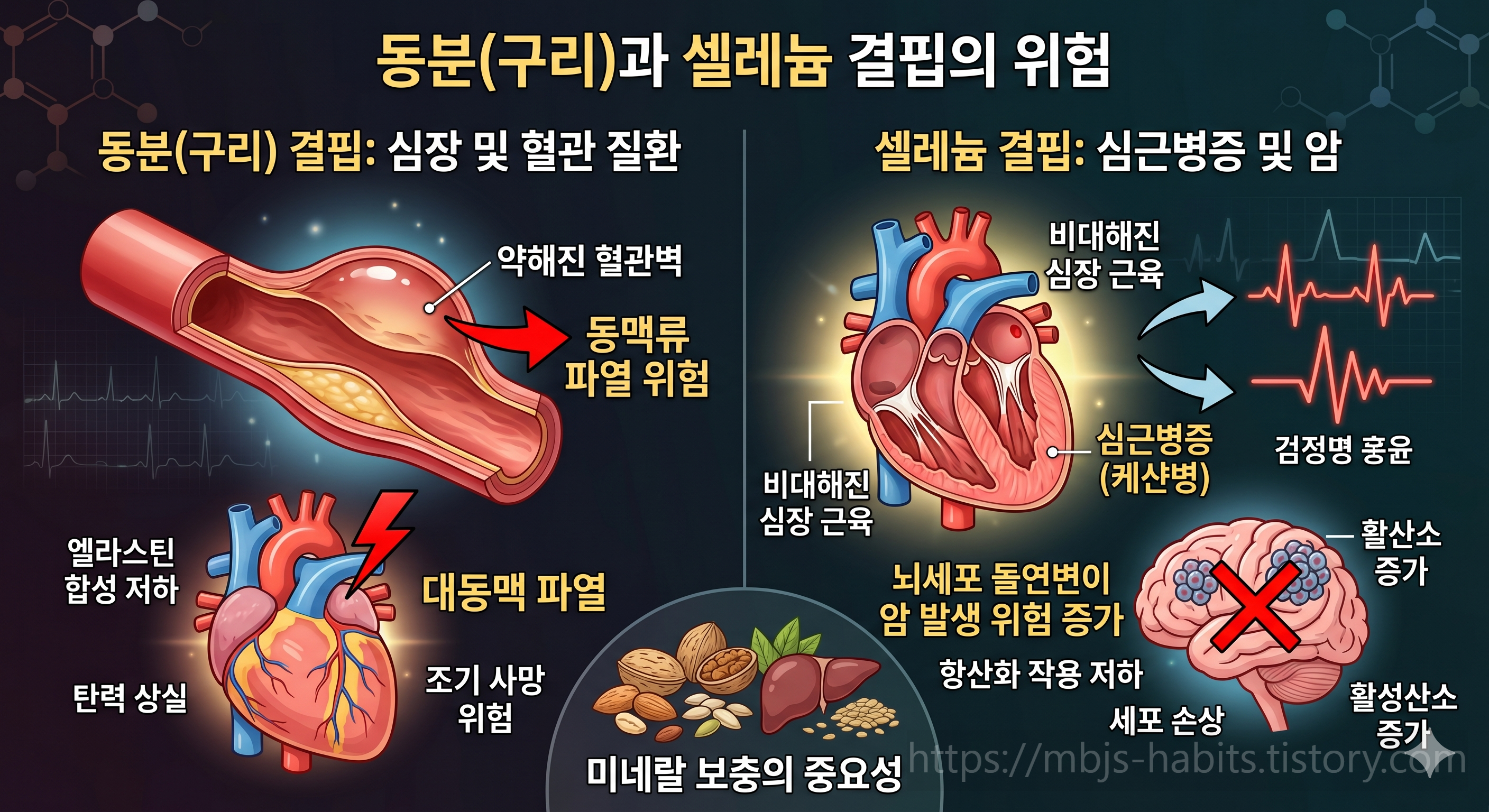 동분(구리)과 셀레늄 결핍의 위험을 설명하는 인포그래픽 이미지. 왼쪽은 구리 결핍으로 인한 심장 및 혈관 질환(약해진 혈관벽, 동맥류 파열 위험, 엘라스틴 합성 저하, 대동맥 파열, 조기 사망 위험)을 보여주고, 오른쪽은 셀레늄 결핍으로 인한 심근병증 및 암(비대해진 심장 근육, 케산병, 뇌세포 돌연변이, 항산화 작용 저하, 활성산소 증가)을 보여주며, 하단 중앙에 미네랄 보충의 중요성을 강조하는 이미지