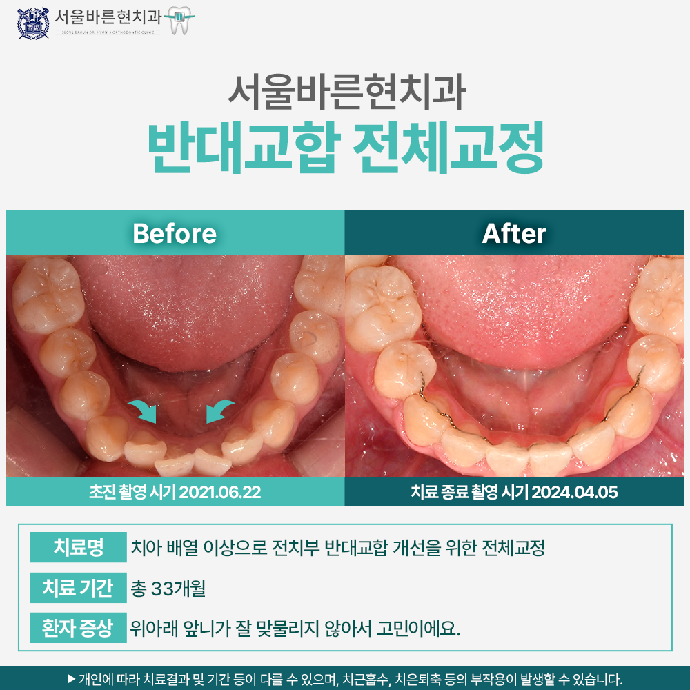 해운대치아전체교정