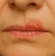 입술에 물집이 생기는 이유
