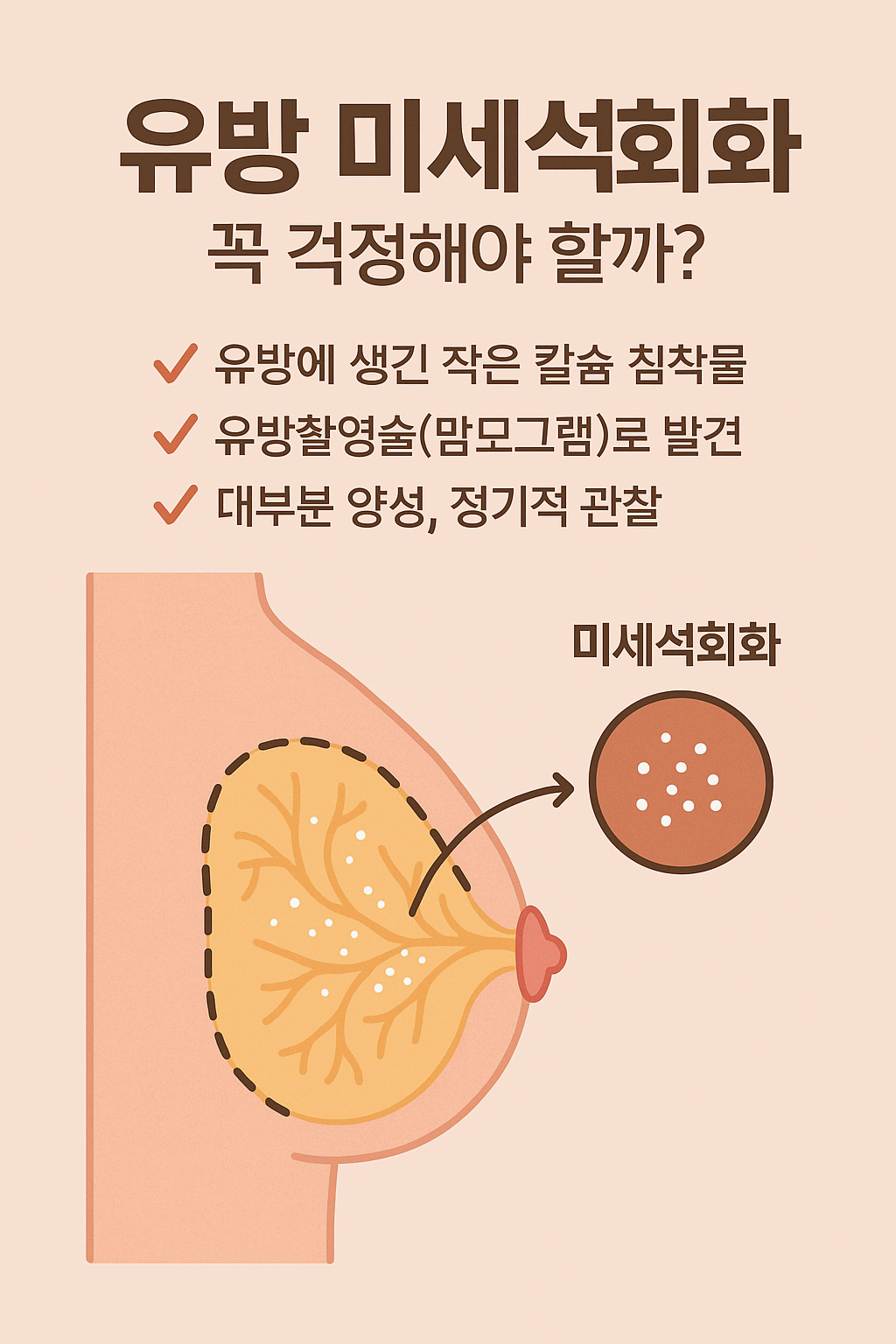 [건강]유방 미세석회화, 꼭 걱정해야 할까?