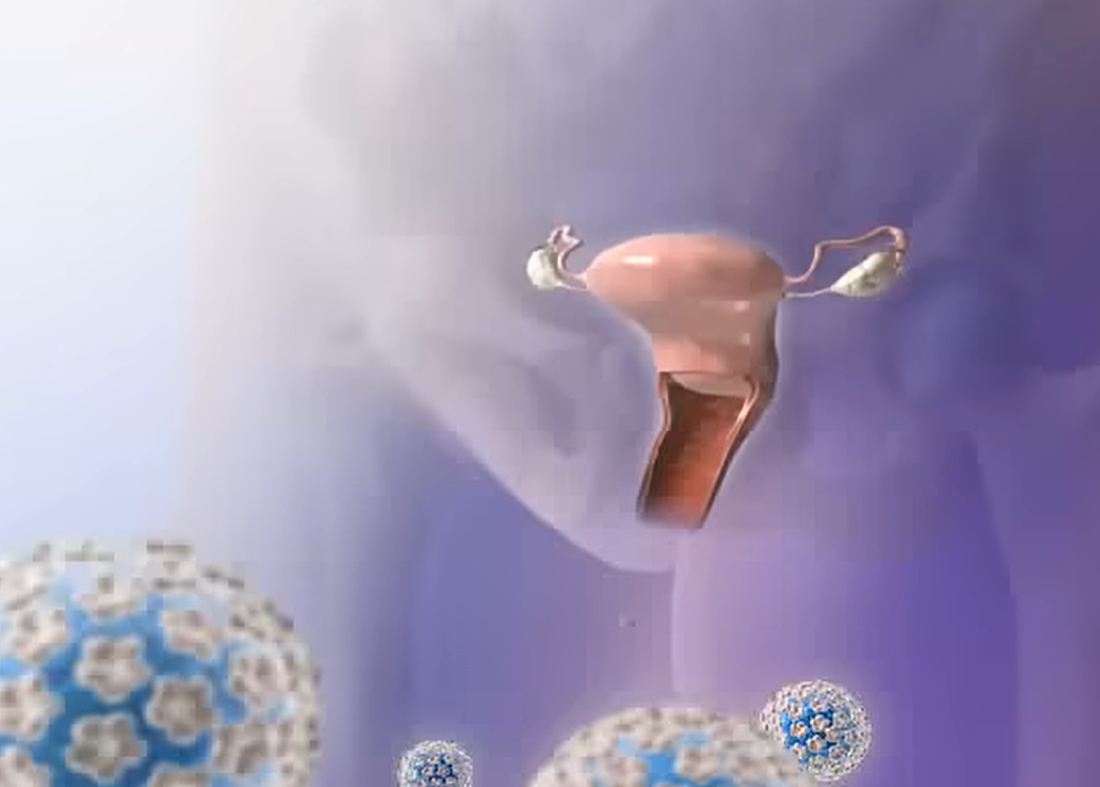 hpv 바이러스 원인
