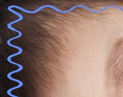 모야모야병 증상