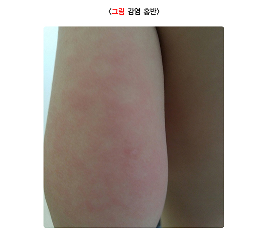 감염홍반, 제5병, 파르보바이러스B19, 소아발진, 평생면역